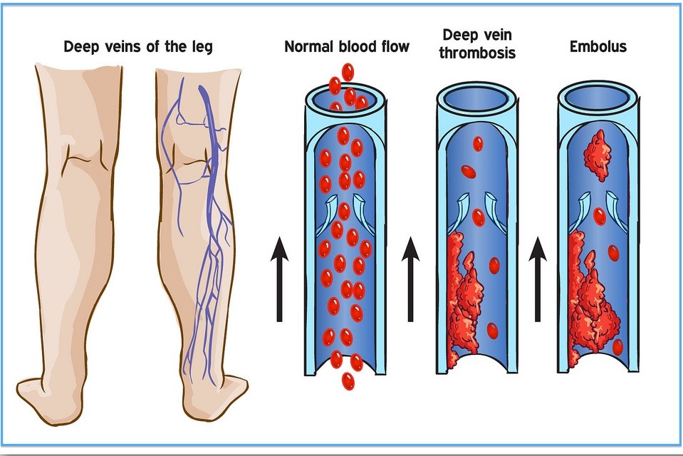 Clinical condition of deep vein thrombosis. A) A poor blood flow