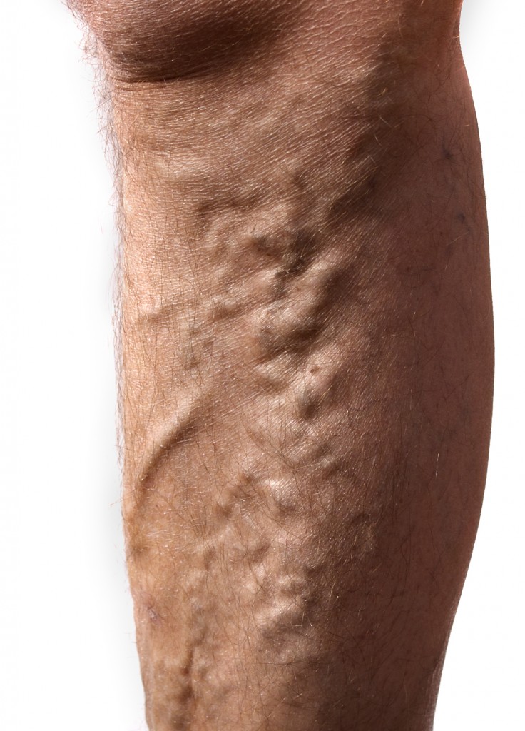 Varicose Veins and Skin Discoloration