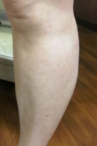After Image: Calf Sclerotherapy
