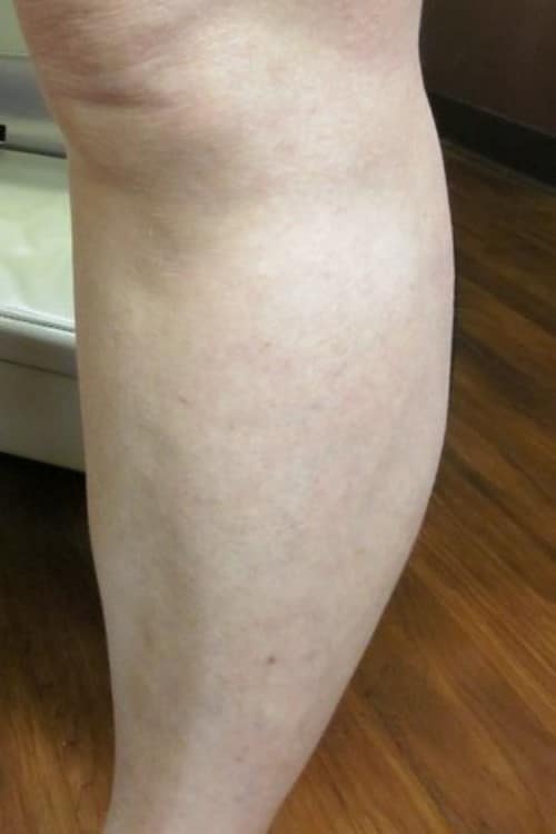 After Image: Calf Sclerotherapy - left-side