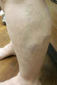 Before Image: Calf Sclerotherapy