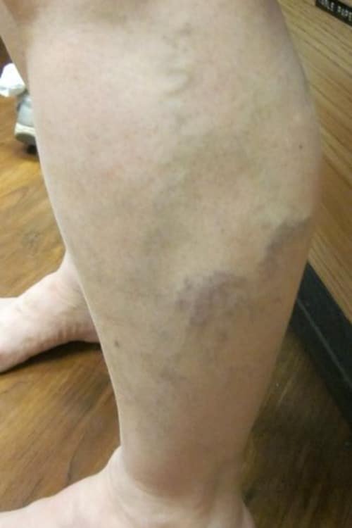 Before Image: Calf Sclerotherapy - left-side