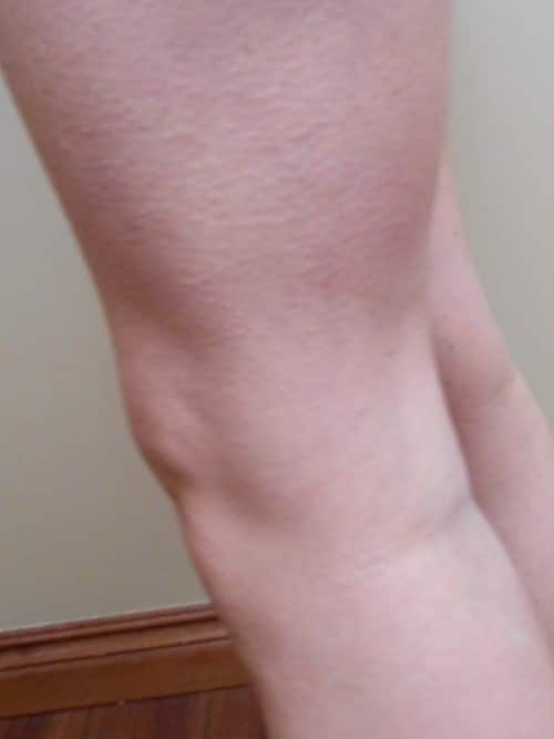 After Image: Cosmetic Sclerotherapy - left-back-oblique