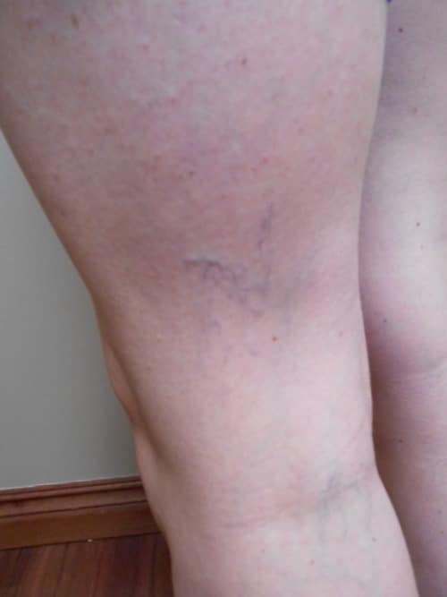 Before Image: Cosmetic Sclerotherapy - left-back-oblique