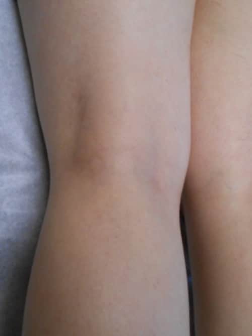 After Image: Cosmetic Sclerotherapy - back