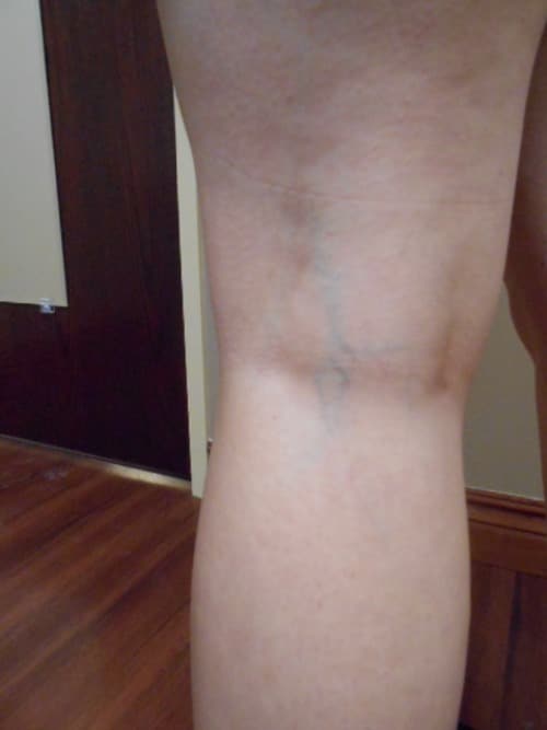 Before Image: Cosmetic Sclerotherapy - back