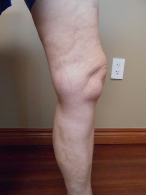 After Image: EVLT Foam Sclerotherapy - right-side