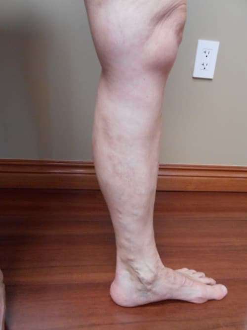 After Image: EVLT Foam Sclerotherapy - right-side