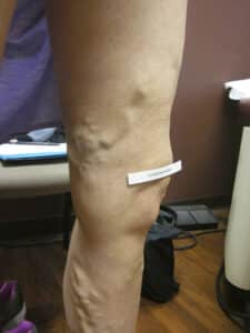 Before Image: EVLT Foam Sclerotherapy