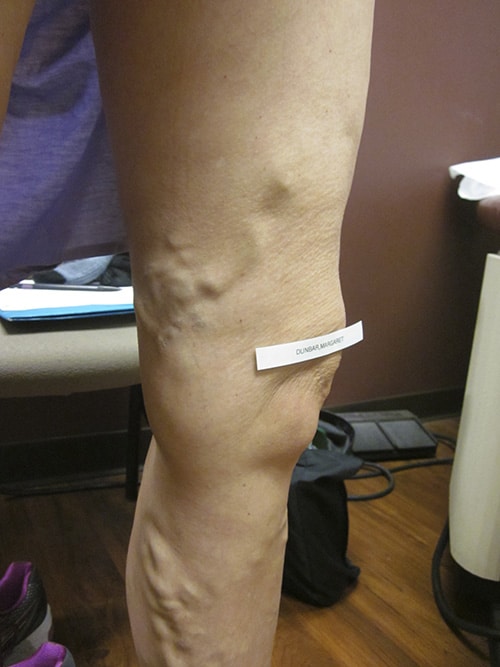 Before Image: EVLT Foam Sclerotherapy - right-side