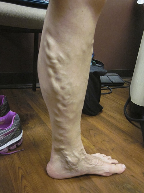 Before Image: EVLT Foam Sclerotherapy - right-side