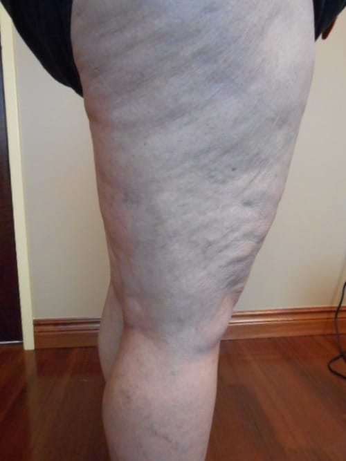After Image: EVLT - right-side