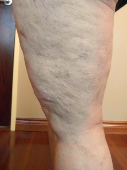 After Image: EVLT - left-side