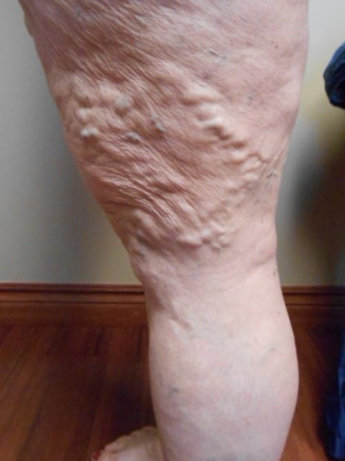 Before Image: EVLT - left-side