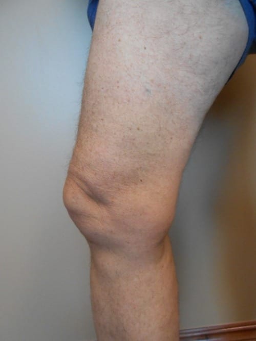 After Image: EVLT - left-front-oblique