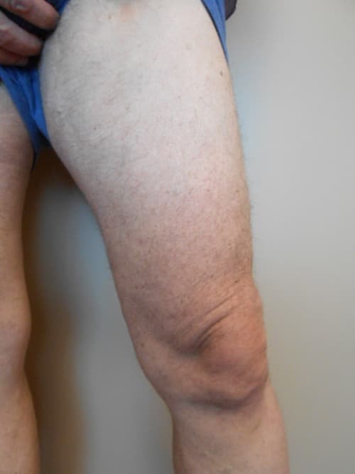 After Image: EVLT - right-front-oblique
