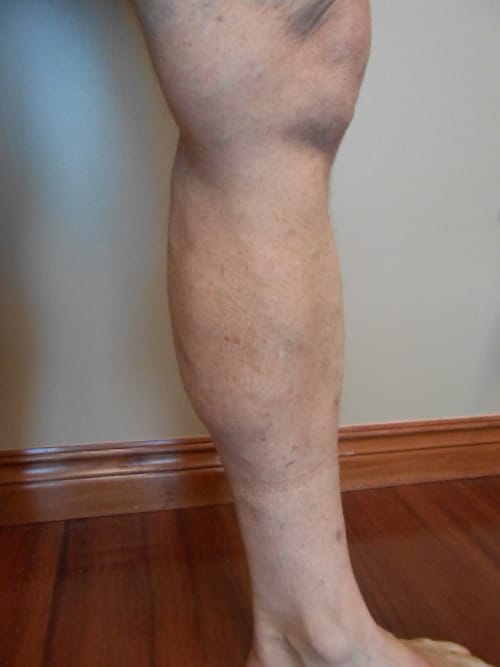 After Image: EVLT - right-front-oblique