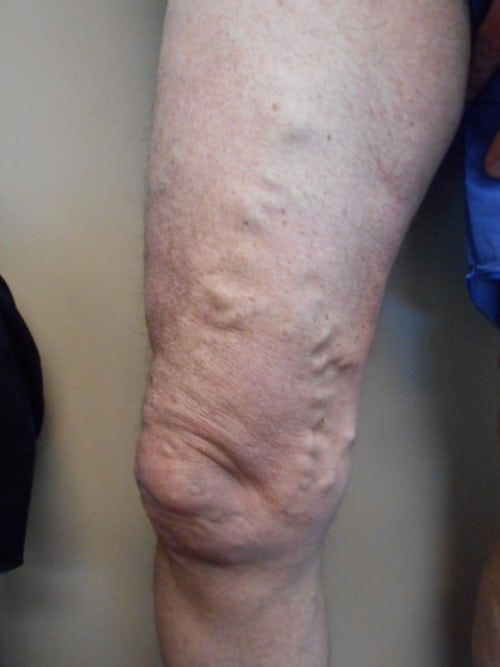 Before Image: EVLT - left-front-oblique