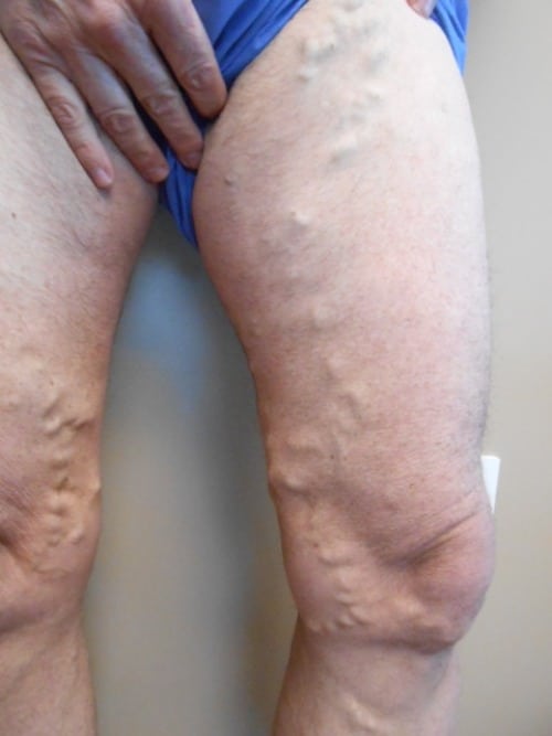 Before Image: EVLT - right-front-oblique