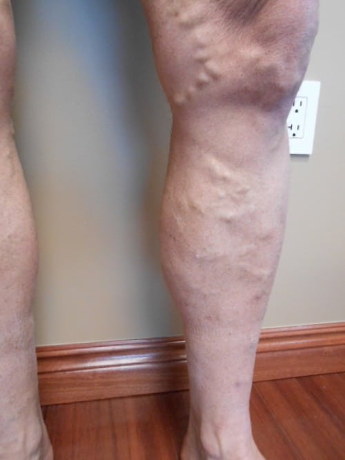 Before Image: EVLT - right-front-oblique