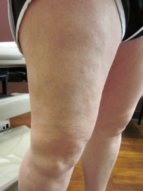 After Image: EVLT - right-front-oblique