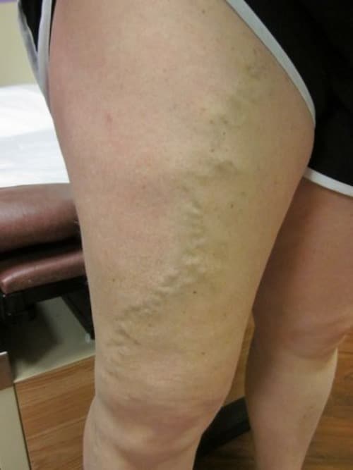 Before Image: EVLT - right-front-oblique