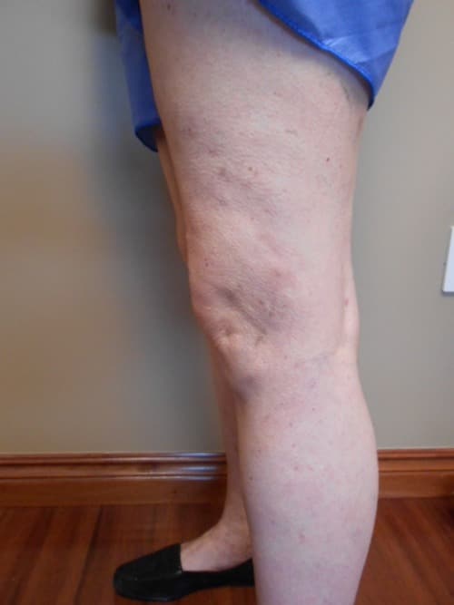 After Image: EVLT - left-front-oblique