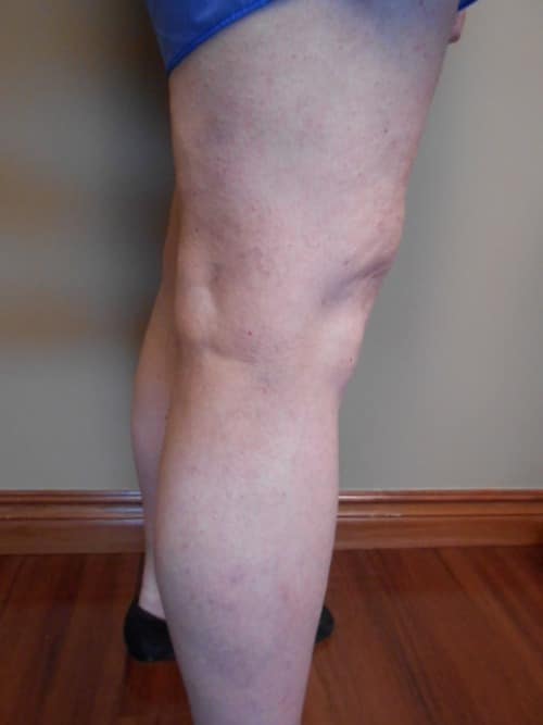 After Image: EVLT - right-side
