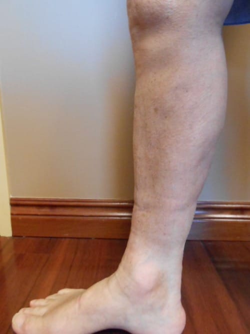 After Image: EVLT - left-side