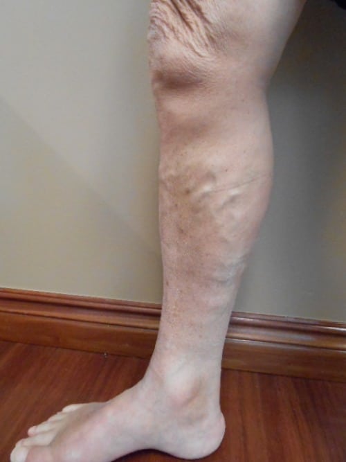 Before Image: EVLT - left-side