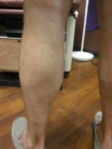 After Image: Man Calf Post RFA