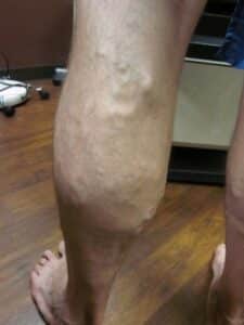 Before Image: Man Calf Post RFA