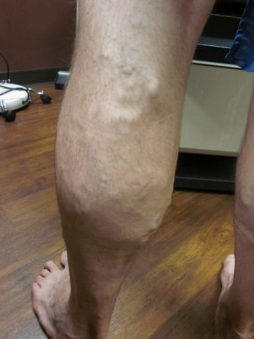 Before Image: Man Calf Post RFA - back