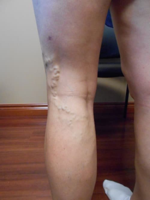 Before Image: RFA - back