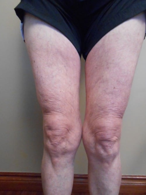 After Image: Sclerotherapy - front