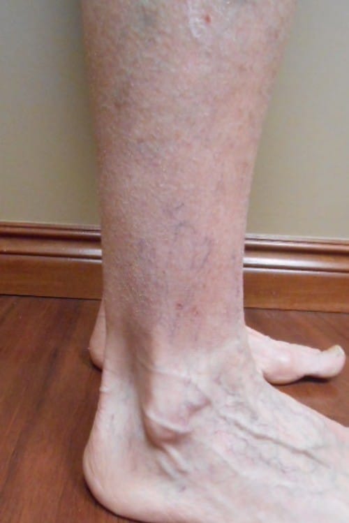 After Image: Sclerotherapy - right-side