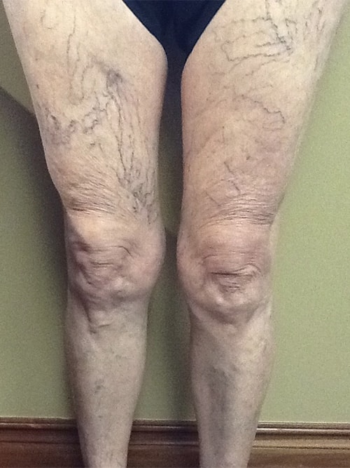 Before Image: Sclerotherapy - front