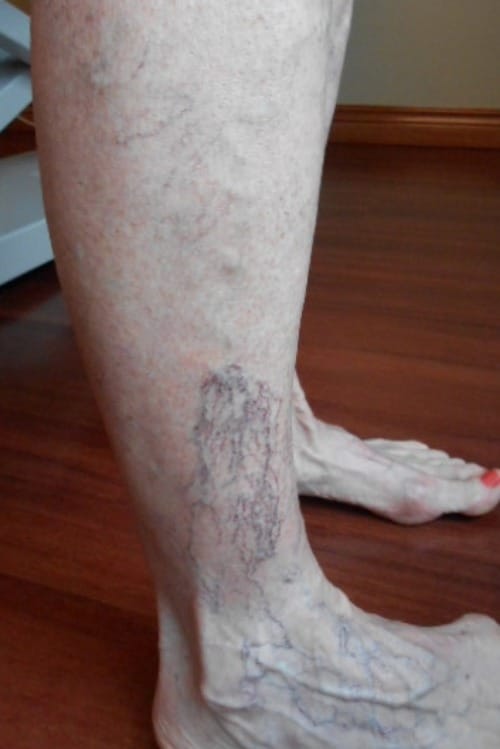 Before Image: Sclerotherapy - right-side