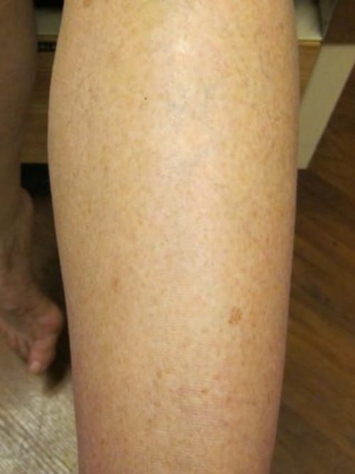 After Image: Sclerotherapy - back