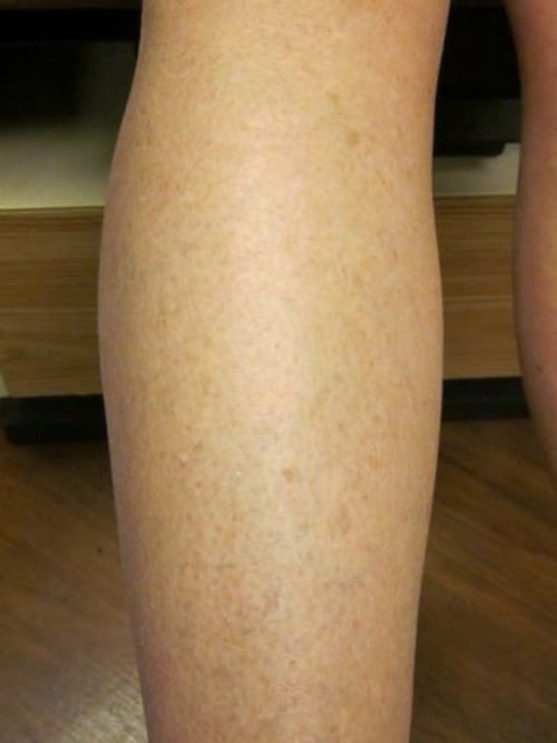 After Image: Sclerotherapy - back