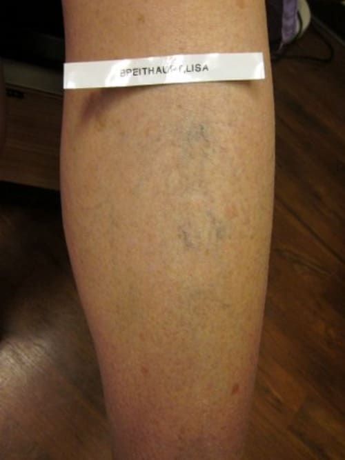 Before Image: Sclerotherapy - back