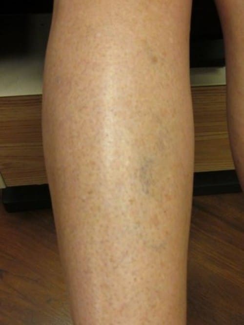 Before Image: Sclerotherapy - back