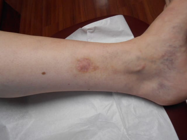 After Image: Venous Ulcer - front