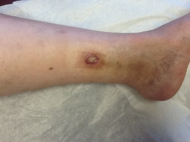 Before Image: Venous Ulcer - front