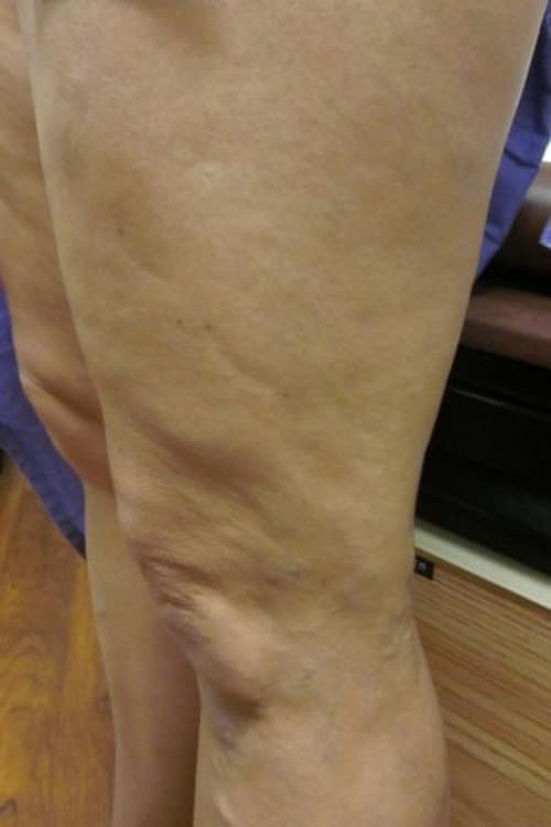 After Image: Post EVLT - left-side