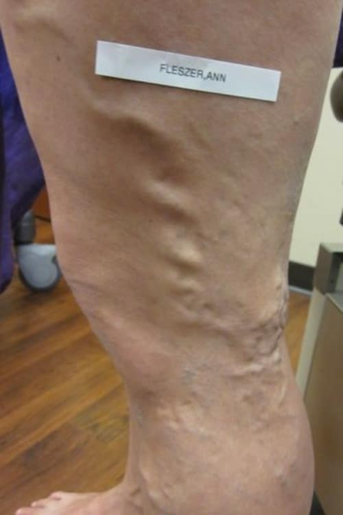 Before Image: Post EVLT - left-side