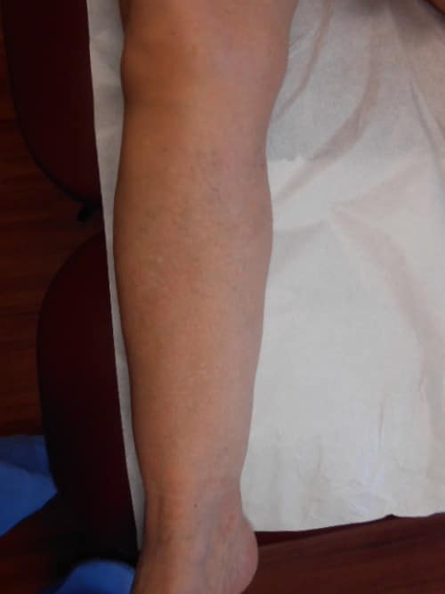 After Image: Right Upper Calf Sclerotherapy - left-front-oblique
