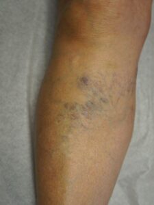 Before Image: Right Upper Calf Sclerotherapy