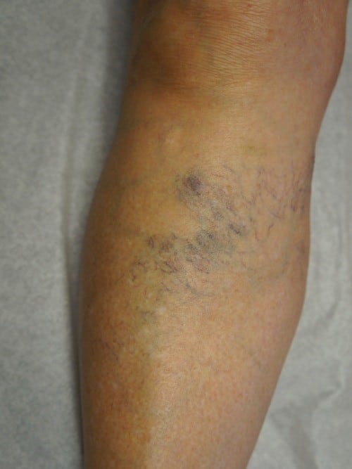 Before Image: Right Upper Calf Sclerotherapy - left-front-oblique