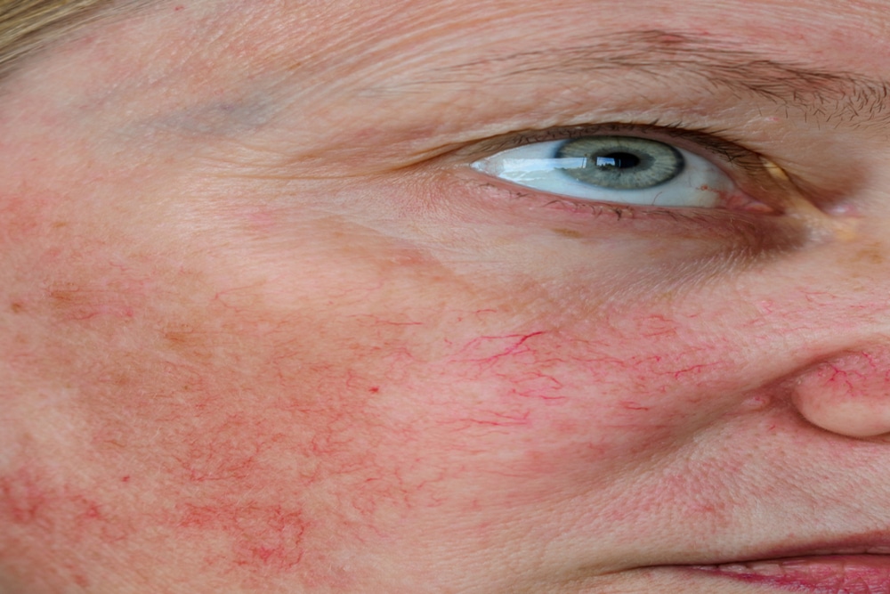 Close-up of a woman’s face showing visible facial veins, vascular stars, and couperose — common signs treated in facial vein removal and skin rejuvenation
